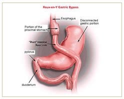 Slider image (6) Panama Gastric Surgery Center